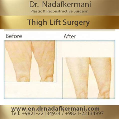 whats a thigh job|Thigh Lift: Procedure, Preparation, Recovery, Pics,。